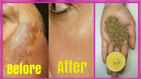 How To Get Rid Of Hyper Pigmentation Freckles Dark Spots Black