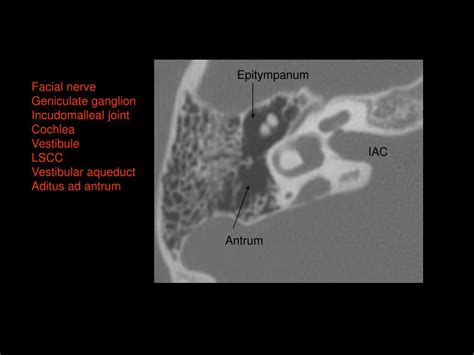 Ppt Ct Temporal Bone Powerpoint Presentation Free Download Id3204041