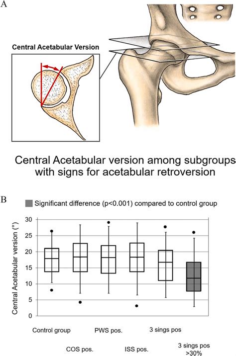 Diagnosis Of Acetabular Retroversion Three Signs Positive And