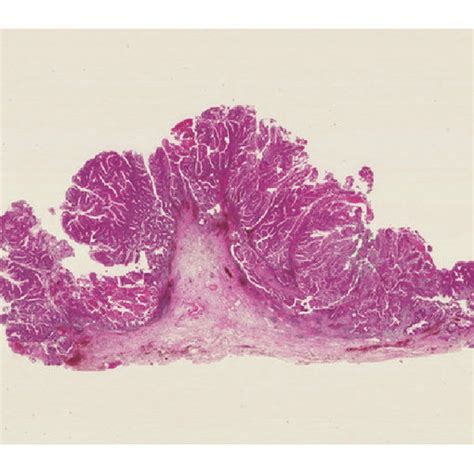 Surgical Specimen Showing The Papillomatous Yellowish Nodular Lesion