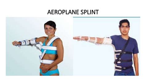 Aeroplane Splint Dnb Orthopaedics Ms Orthopedics Mrcs Exam Guide