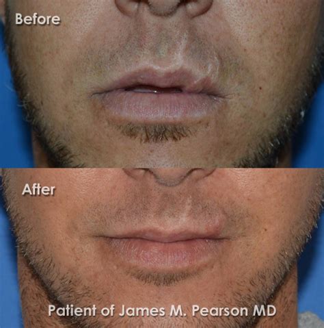 Lip Reconstructive Surgery Before And After Photos Dr James