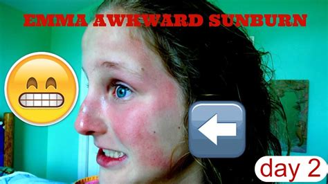 Emma Gets A Awkward Sunburn Spring Break Day 2 Youtube