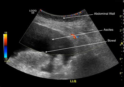 Condition Specific Radiology Ascites Stepwards