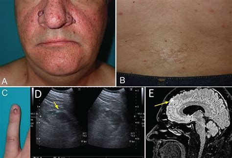 Tuberous Sclerosis Complex Cleveland Clinic Journal Of Medicine