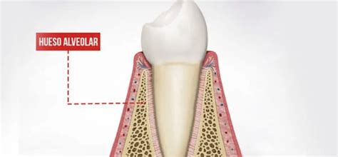Alveolitis Dental Tipos Y Cómo Prevenir Su Aparición Ferrusandbratos