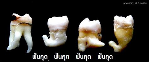 Pin On Wisdom Tooth