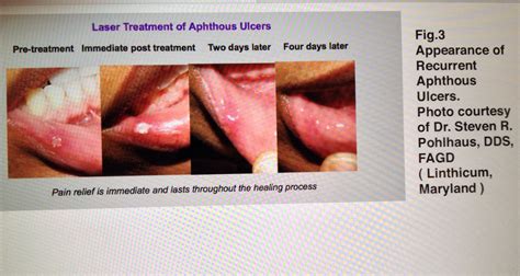 The clinical herpes pictures on this page may be disturbing to some people. Mouth Sores