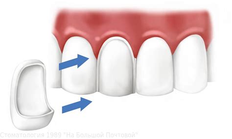 Carillas De Porcelana El Tratamiento Paso A Paso Directorio Odontológico