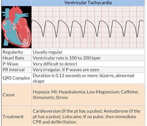 Ventricular Tachycardia Nursing Study Tips Nursing School Essential