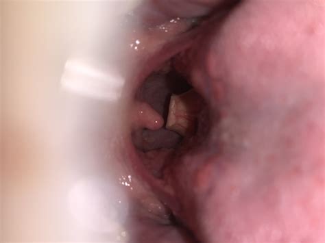 What Could This Be Herpes Hpv Oral Cancer Herpes Non Genital Forums Patient