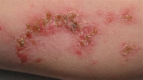 Purulent Skin Infections The Most Common Skin Diseases How To Fight