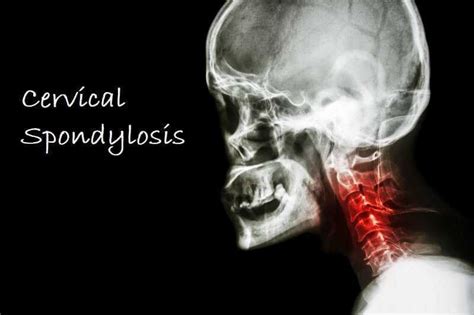 Cervical Spondylosis Signs And Symptoms