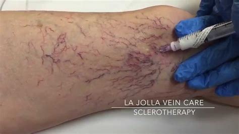 Sclerotherapy Procedure Video La Jolla Vein Care