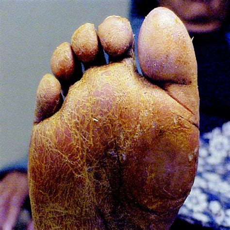 A Guide To Skin Conditions Of The Diabetic Foot