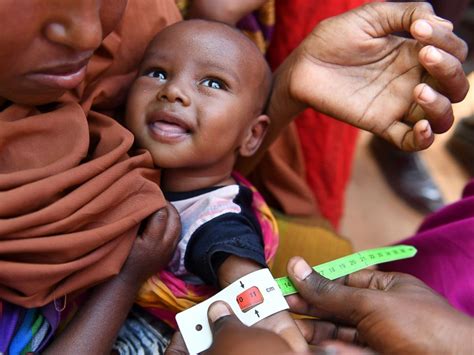 14m Children In Somalia To Suffer Acute Malnutrition In 2017 Unicef