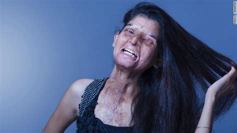 Acid Attack Victims In Ground Breaking Photo Shoot