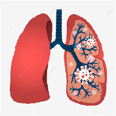 Pneumonia Clipart Transparent Background Lung Pneumonia Symptoms The Best Porn Website