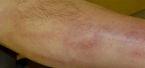 What Is Superficial Thrombophlebitis