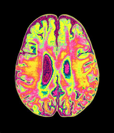 Coloured Mri Scan Of Organophosphate Brain Damage Photograph By Mehau Kulyk