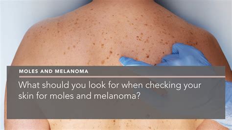What Should You Look For When Checking Your Skin For Moles And Melanoma Penelope Pratsou