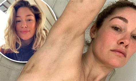 Model Erin McNaught Shows Off Her Bruised Body After Her Jump Out Of A