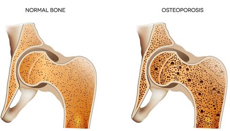 Osteoporosis — Treatment Symptoms And Bone Health Msk Australia