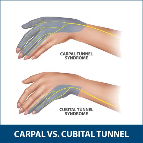 Ulnar Tunnel Syndrome Surgery