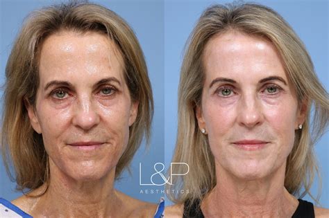 Terrific Trl Laser For Bay Area Woman