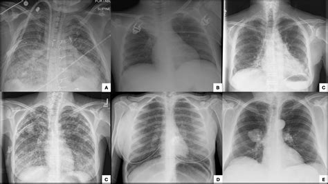 Fundamental Radiological Findings Algorithmic Approach To Lung Opacities Stepwards