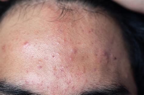 Backgrounds Of Lesions Skin Caused By Acne On The Face Stock Image