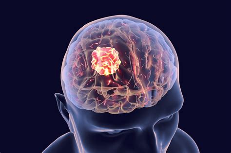Why Is A Brain Tumor So Often Bad News Time News