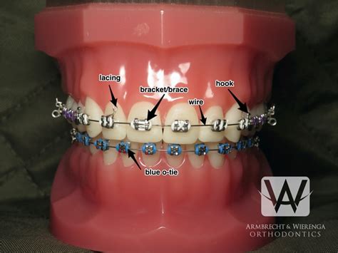 Braces Care Guide Frequently Asked Questions About Braces Grand
