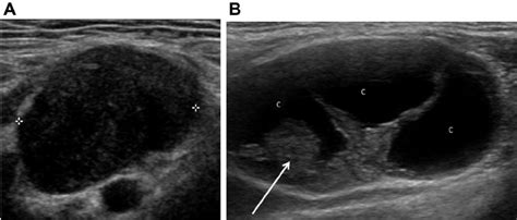Abnormal Lymph Node Neck Ultrasound