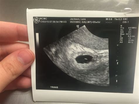 5 Weeks 5 Days Pregnant Babys First Sonogram ️ Ultrason Erkek