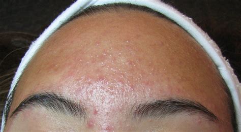 Forehead Acne Its Causes And Remedies