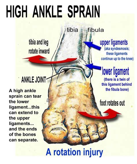 The 25 Best Ankle Sprain Recovery Ideas On Pinterest Ankle Pain