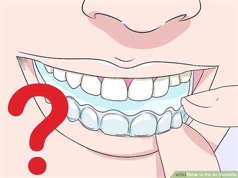 Correcting an overbite isn't just for aesthetics. How to Fix an Overbite: 9 Steps (with Pictures) - wikiHow