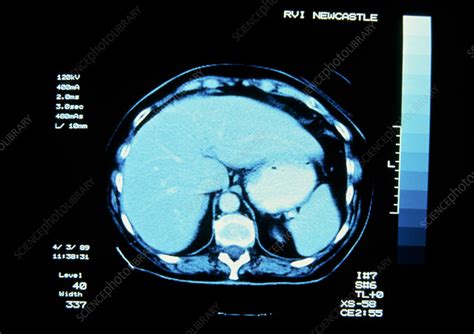 Ct Scan Of Normal Liver Stock Image P5300030 Science Photo Library