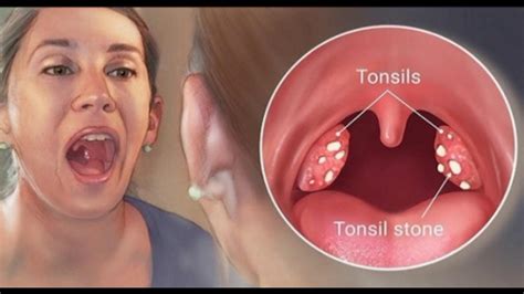 4 Effective Ways To Remove Tonsil Stones Without Surgery Youtube