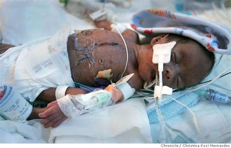 Stanford A Small Medical Wonder Baby Is Smallest To Survive Open