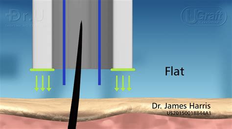 Cutting-Edge Breakthroughs: How FUE Technique is Evolving – B7 Clinics