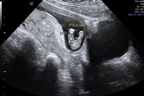 13 Week Ultrasound Pictures Gender