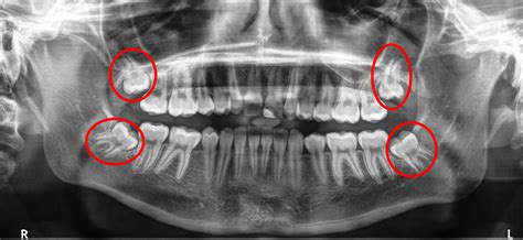 Wisdom Teeth Mcmurray Pa Third Molars Impacted Tooth