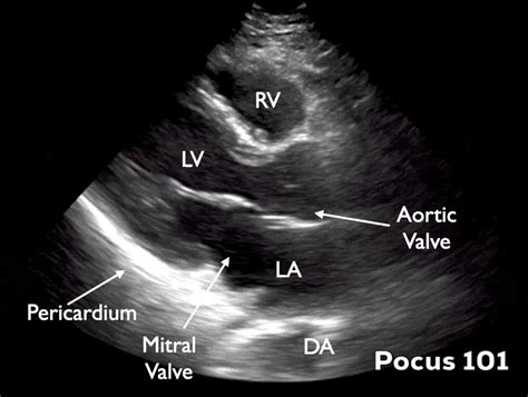 Measuring Cardiac Output With Echocardiography Made Easy Pocus 101 2024