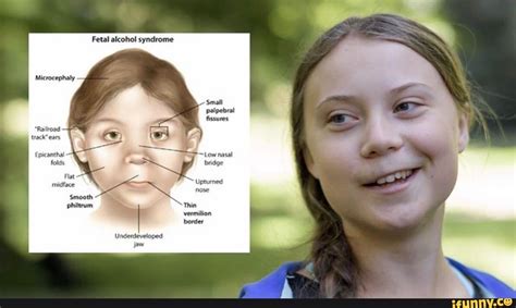 In asians it is normal, but in caucasians it may indicate an underlying syndrome. Fetal alcohol syndrome "Railrosd track" ears Epicanthal Ne folds bridge Flat mmidface - nose ...