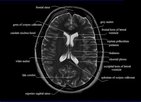 Mri Anatomy Brain Axial Image 17 Mri Brain Brain Anatomy Mri