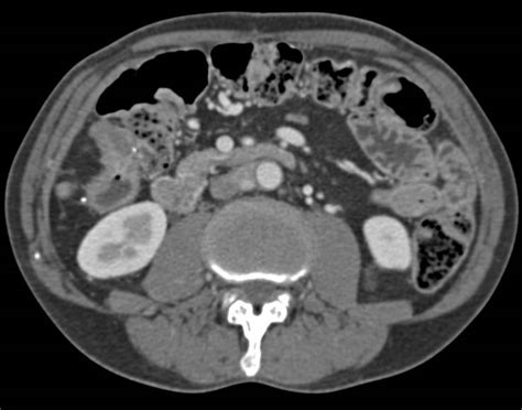 Carcinoid Tumor With Implants On Diaphragm Liver And Paracardiac Nodes