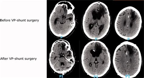 Full Article Post Traumatic Hydrocephalus Incidence Risk Factors