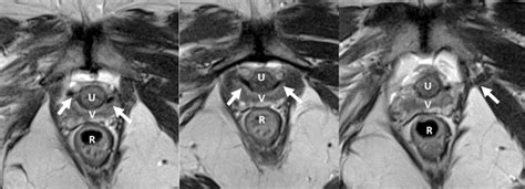 axial t2 weighted t2w images showing linear hypointense download scientific diagram